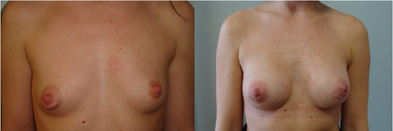 Anatomski implantati -  255mL